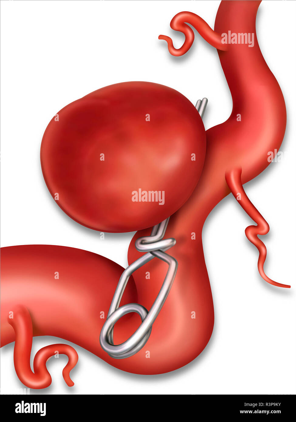 Clipping ist die Operation eines Hirnaneurysmas in einer Arterie. Es ist die Wand eines Blutgefäßes, die es auswölben und überlaufen lässt und brechen kann. Stockfoto