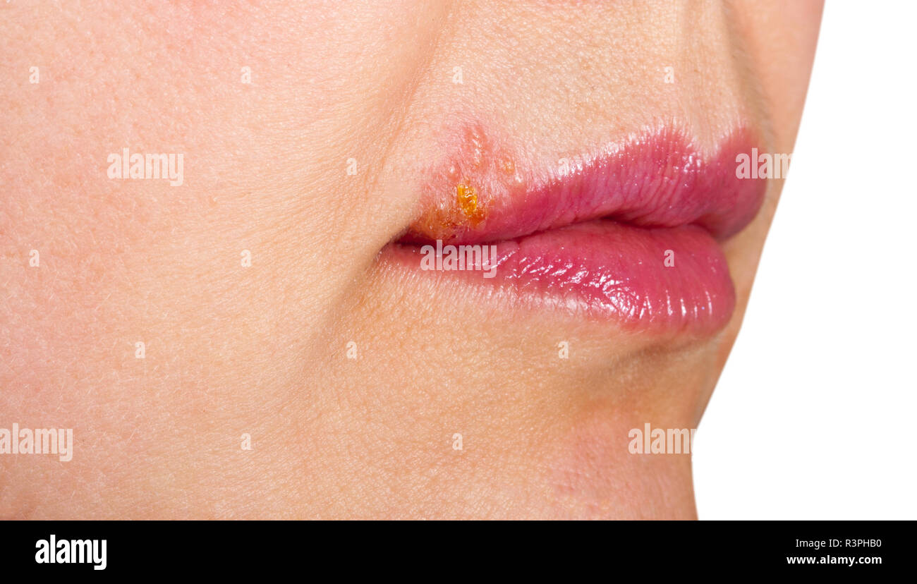 Herpes an der Lippe Nahaufnahme Makro Stockfoto