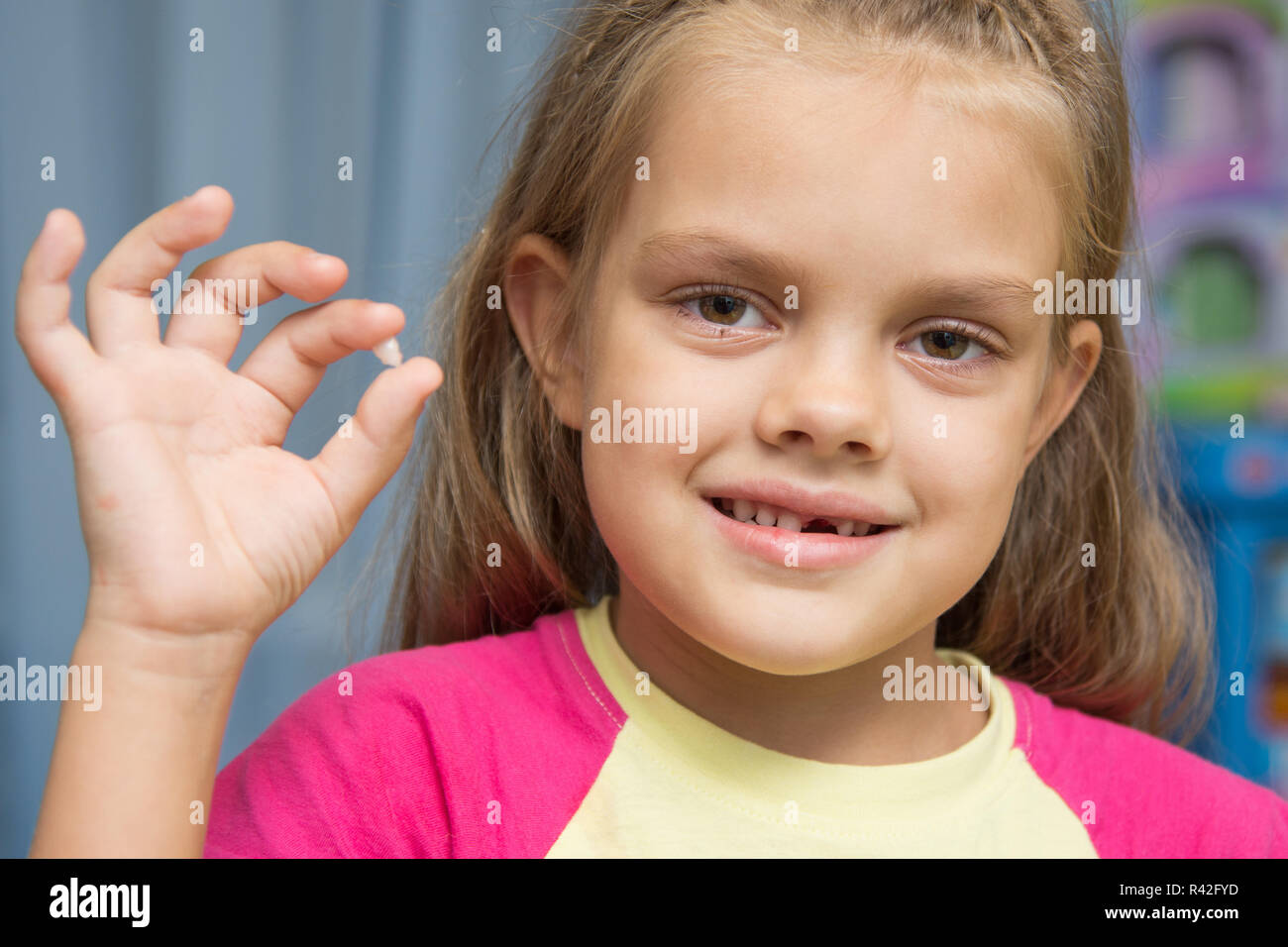An den fünf Jahre alten Mädchen fiel der oberen vorderen baby Zahn Stockfoto