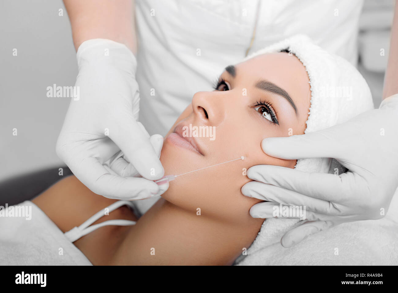 Ästhetische Gesichtschirurgie, kosmetische Technik, mesothreads anheben und konturierung Gesicht Stockfoto