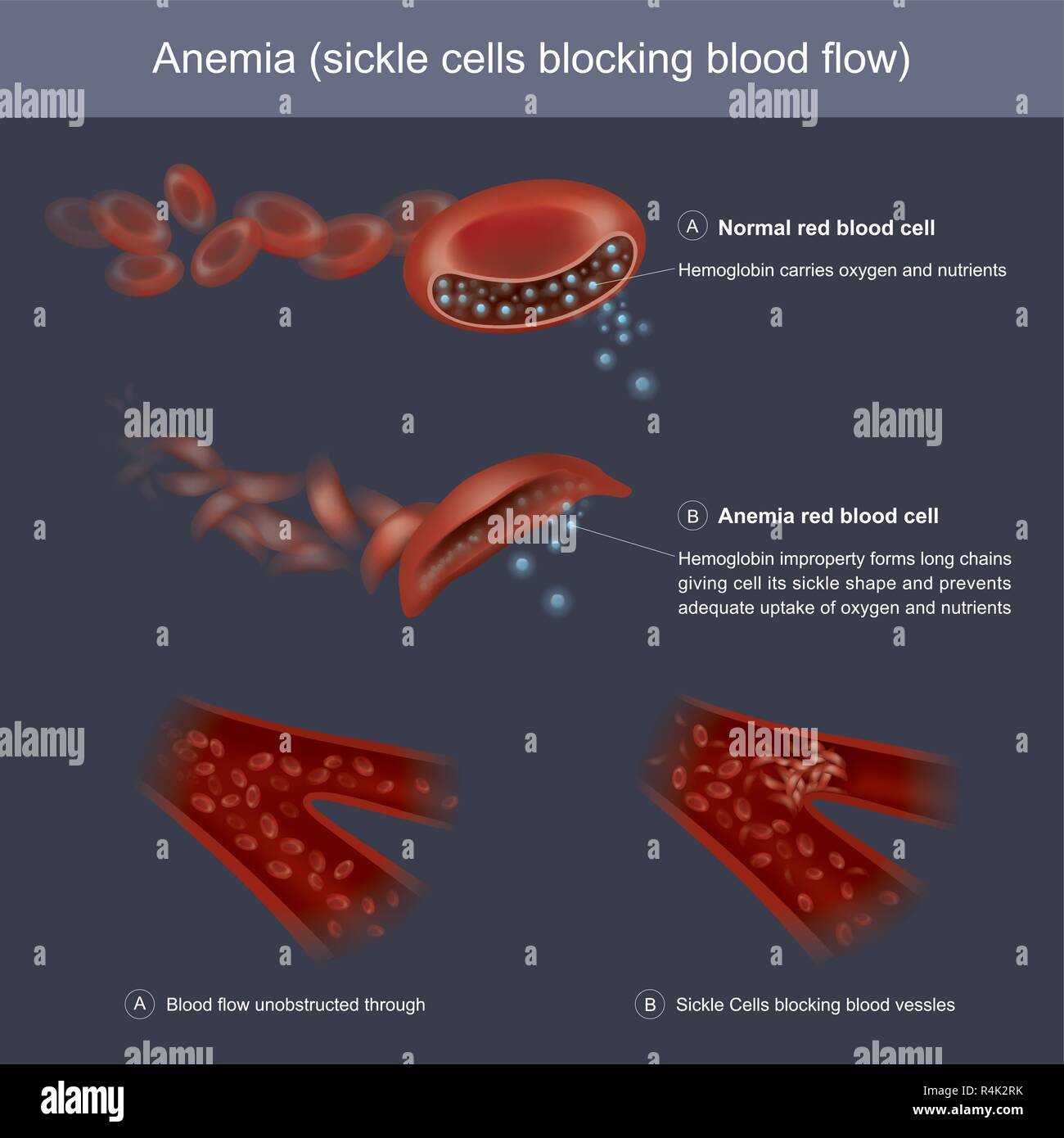 Hämoglobine Formen unsachgemäß lange Ketten, die Zelle seine Sichelform und verhindert eine ausreichende Aufnahme von Sauerstoff und Nutrien Stock Vektor