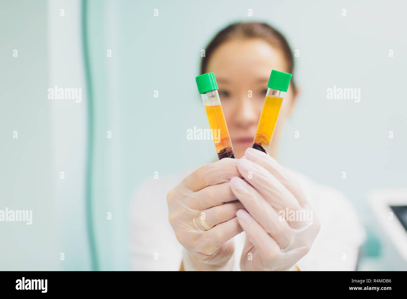 Vorbereitung für Plasmolifting. Blut Rohre in zwei Ebenen geteilt durch die Zentrifuge nach. kosmetische Manipulation. Stockfoto