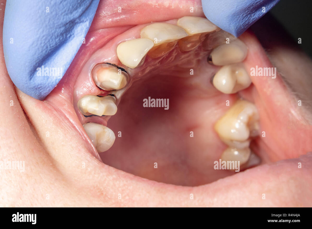 Menschliche Zahn close-up während der Behandlung und Prothetik mit metall-keramische Kronen. Das Konzept der prothetischen Zahnheilkunde Stockfoto