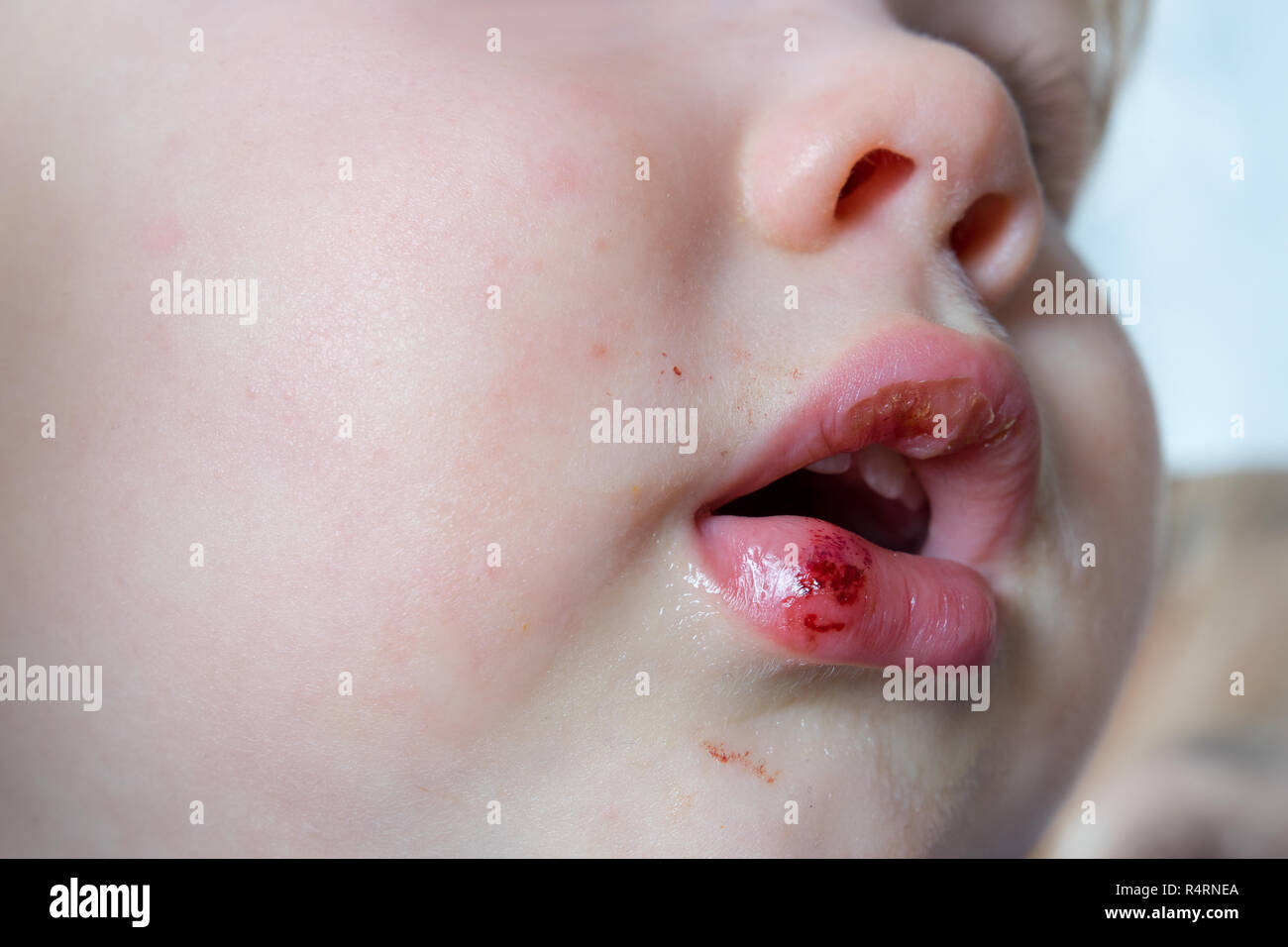 Close-up baby gequetschten verletzte Lippe nach Fallen. Kinder Traumata Konzept. Stockfoto