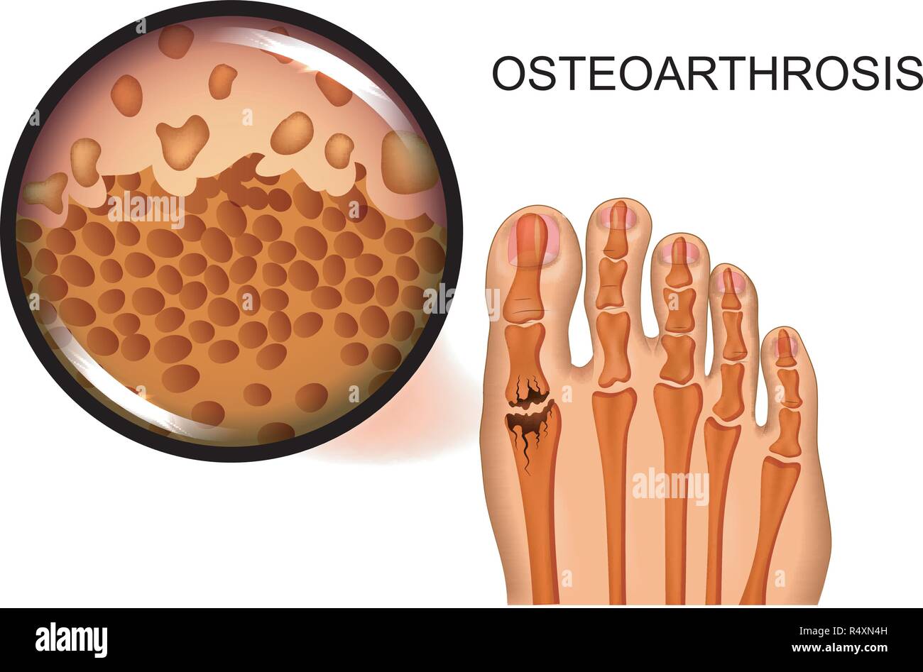 Vector Illustration der Zerstörung der gemeinsamen der Großzehe in Arthrose Stock Vektor