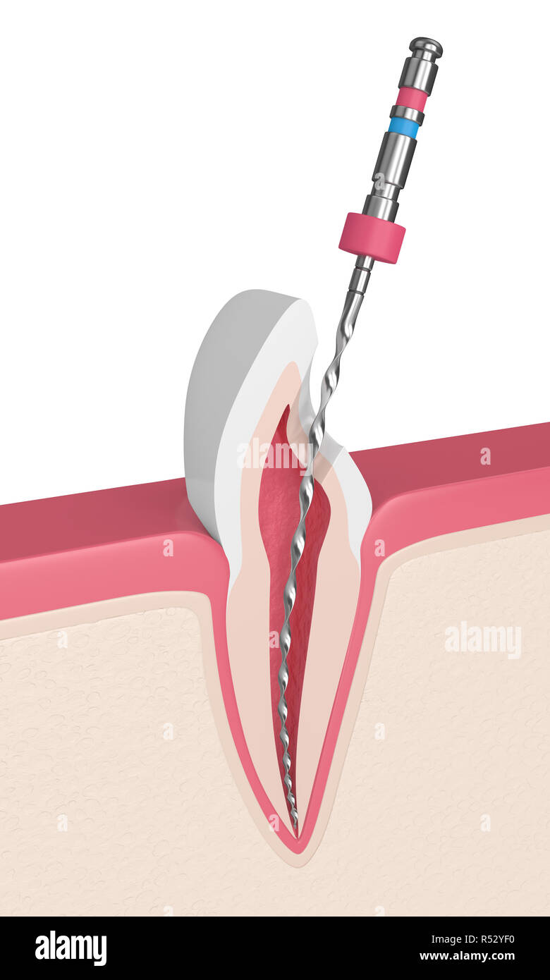 3D-Render von Zahn mit Endodontischen Datei im Zahnfleisch. Wurzelbehandlung Konzept. Stockfoto