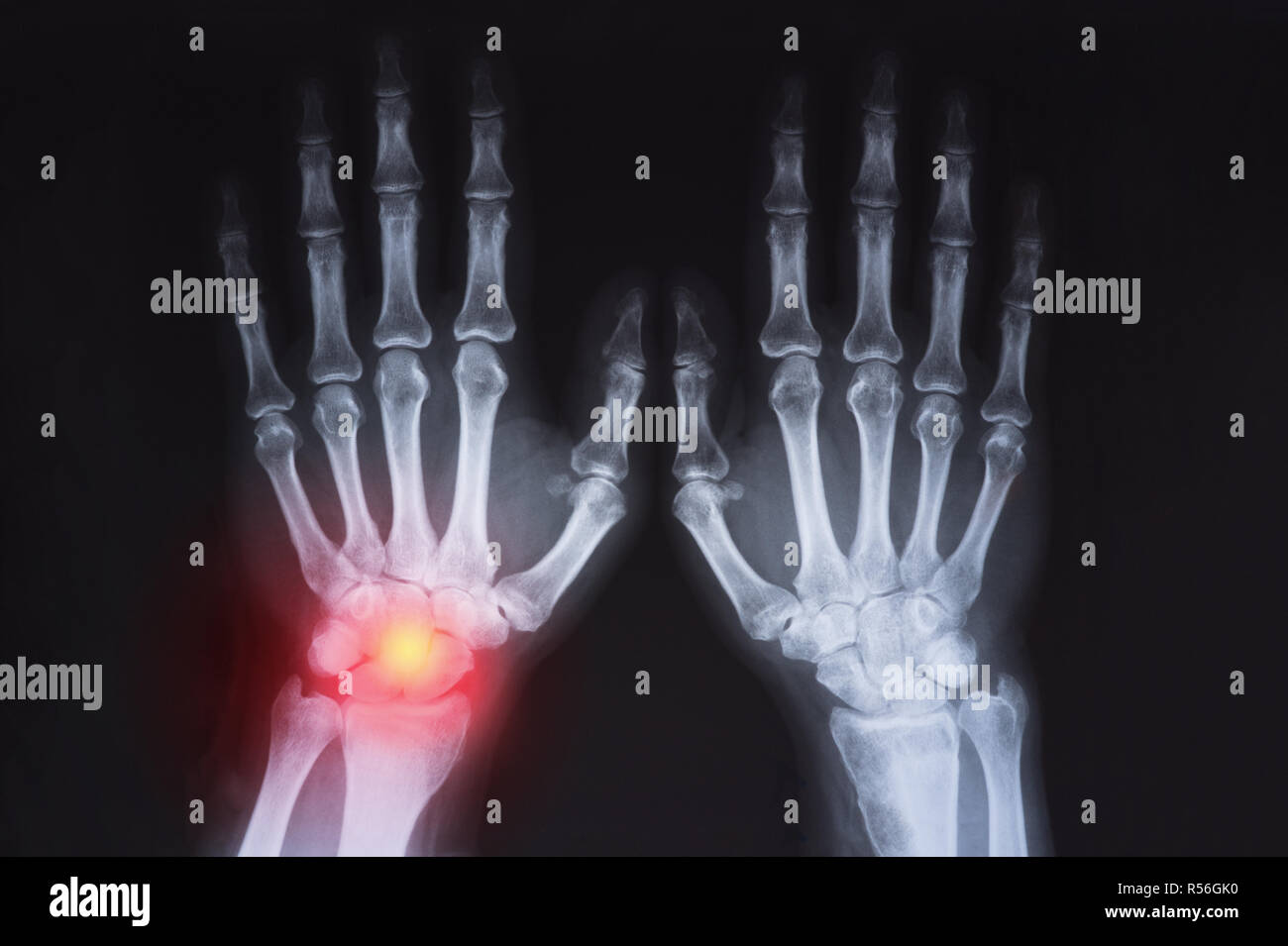 Die menschliche Hand x-ray rot markiert Stockfoto