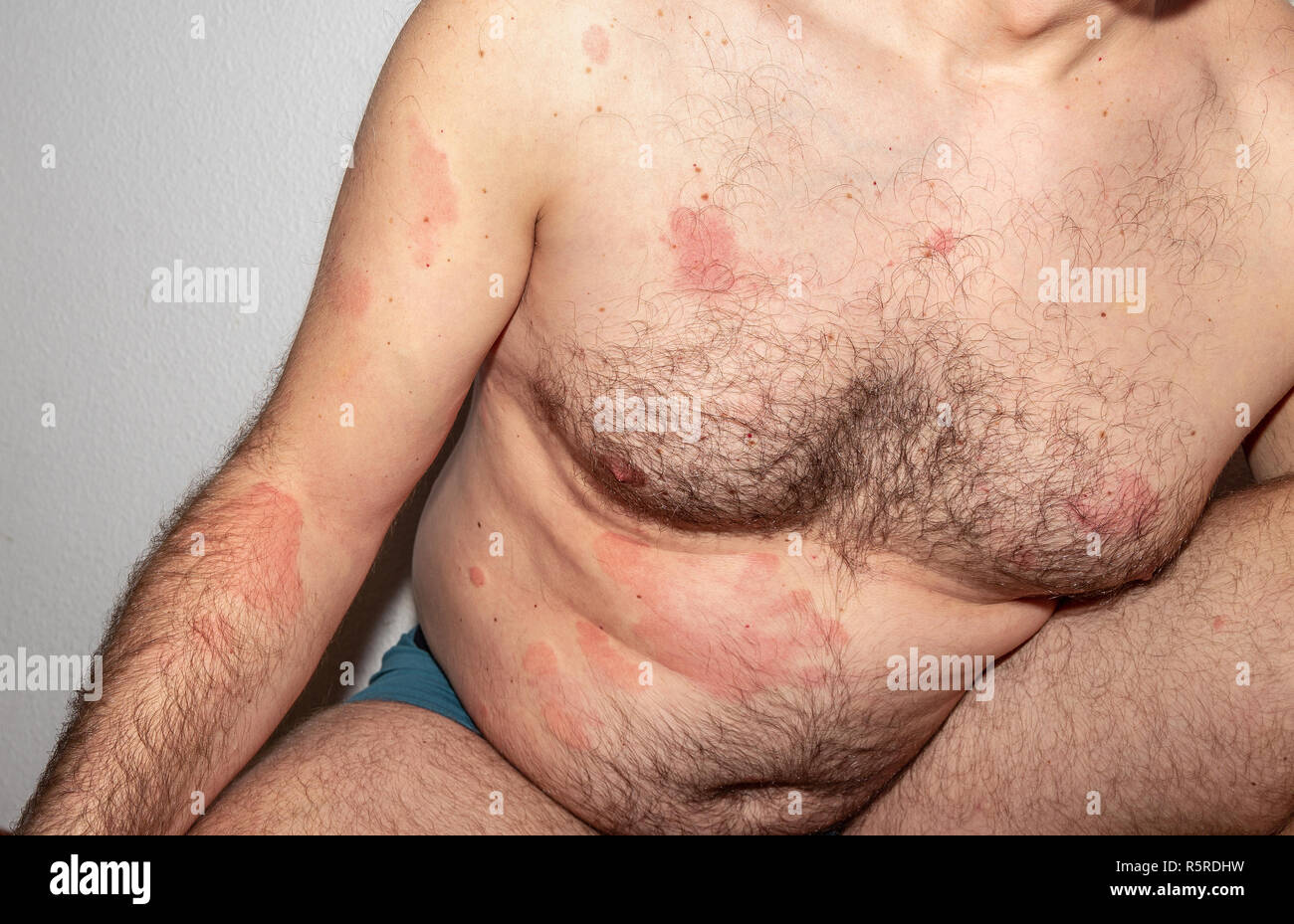 Mann mit Dermatitis Problem der Hautausschlag. Allergie Hautausschlag. Histamin Reaktion Stockfoto