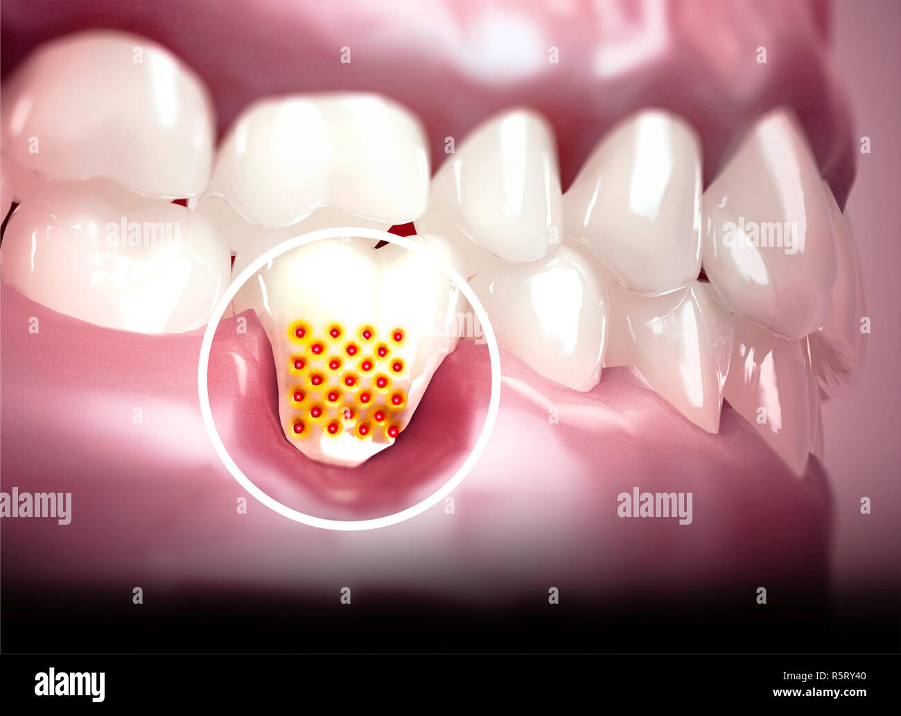 Mund, Zähne, Zahnfleisch. Empfindliche Zähne, Rückzug des Zahnfleisches. Zahnmedizinischen Empfindlichkeit. Dentallabor. 3D-Rendering Stockfoto