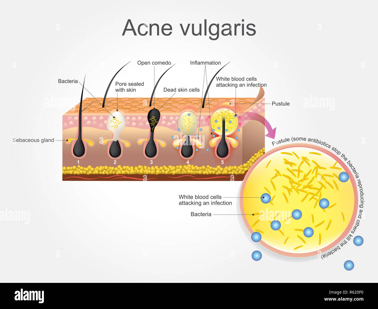 Akne Vulgaris Stockfoto