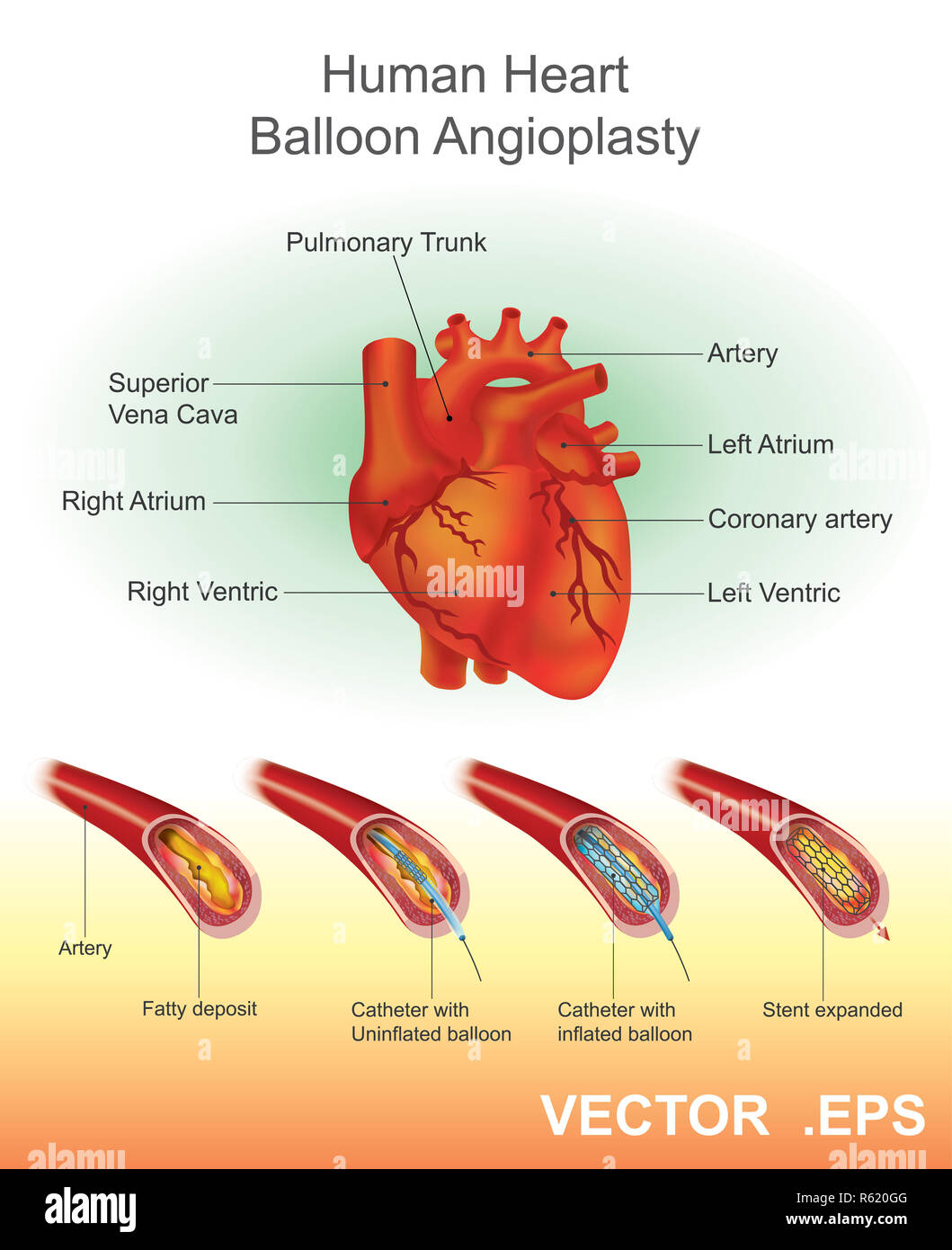 Menschliche Herz Ballon Angioplastie. Vektor, Illustration. Stockfoto