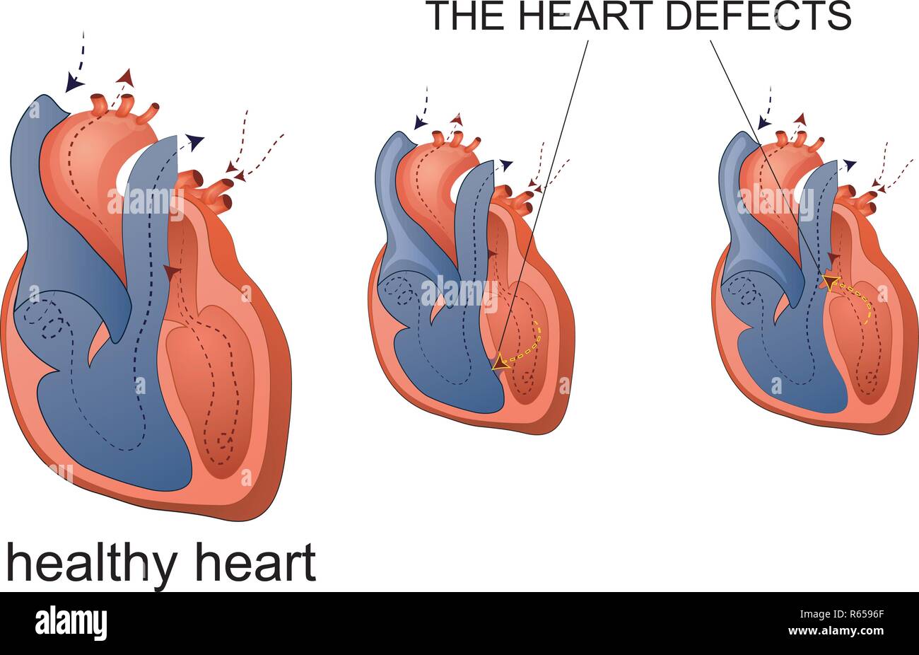 Abbildung: Gesundes Herz- und Herzkrankheit Stock Vektor
