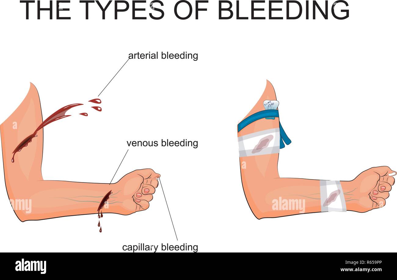 Abbildung: Hand mit der Art der Blutung. Die Einführung von blutstillung Tourniquet und einen Druckverband Stock Vektor