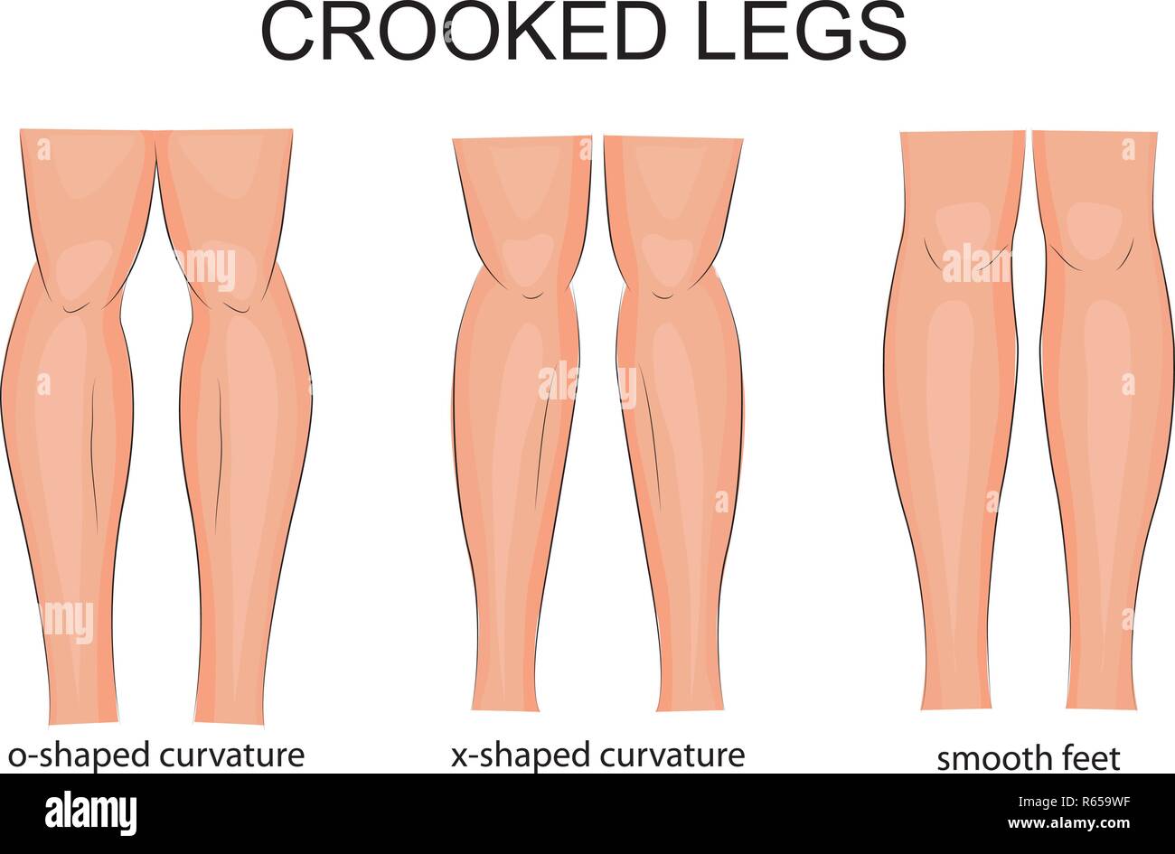 Abbildung: Arten der Krümmung der Beine Stock Vektor
