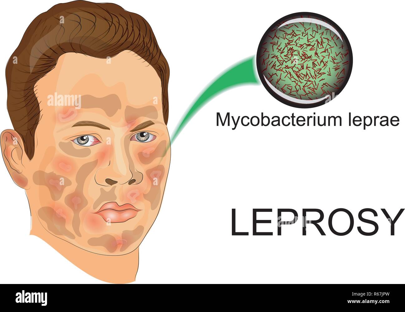 Abbildung: Person Kranken leiden von Lepra und der Agent dieser Krankheit unter dem Mikroskop Stock Vektor