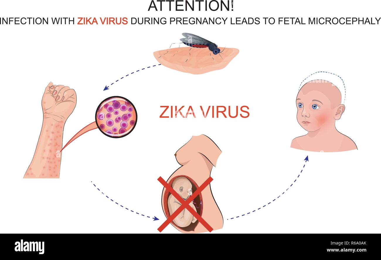 Darstellung der Auswirkungen der Infektion durch zika Virus für schwangere Frauen Stock Vektor
