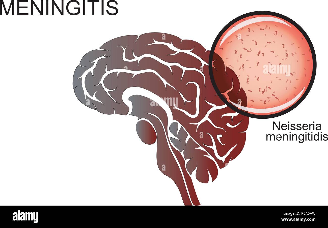 Abbildung des Gehirns, Meningitis, der Erreger der Meningitis. Neurowissenschaften Stock Vektor