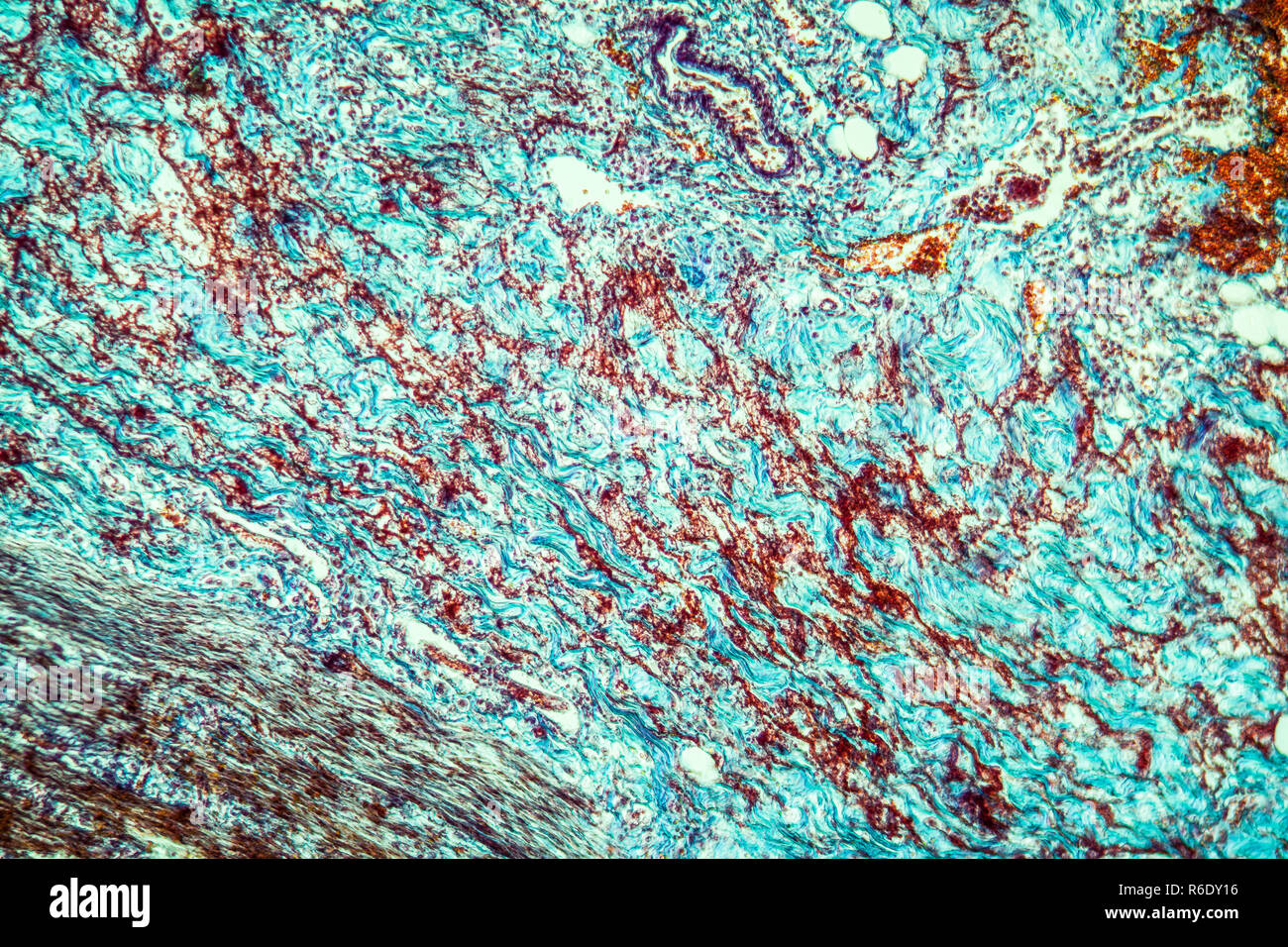 Colitis in der Dysenterie erkrankte Gewebe 100x Stockfoto