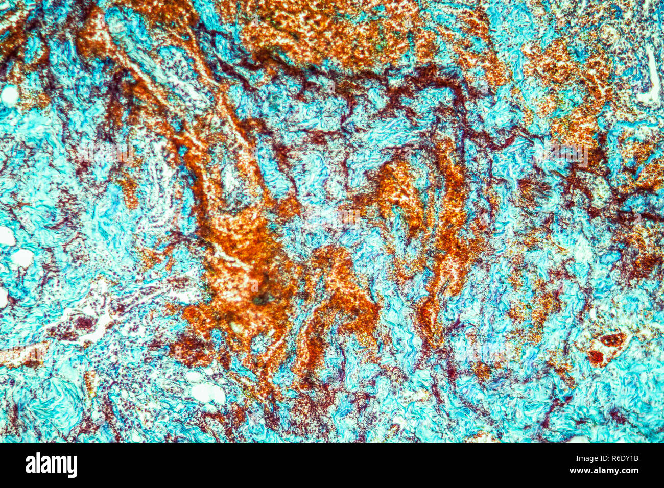 Colitis in der Dysenterie erkrankte Gewebe 100x Stockfoto