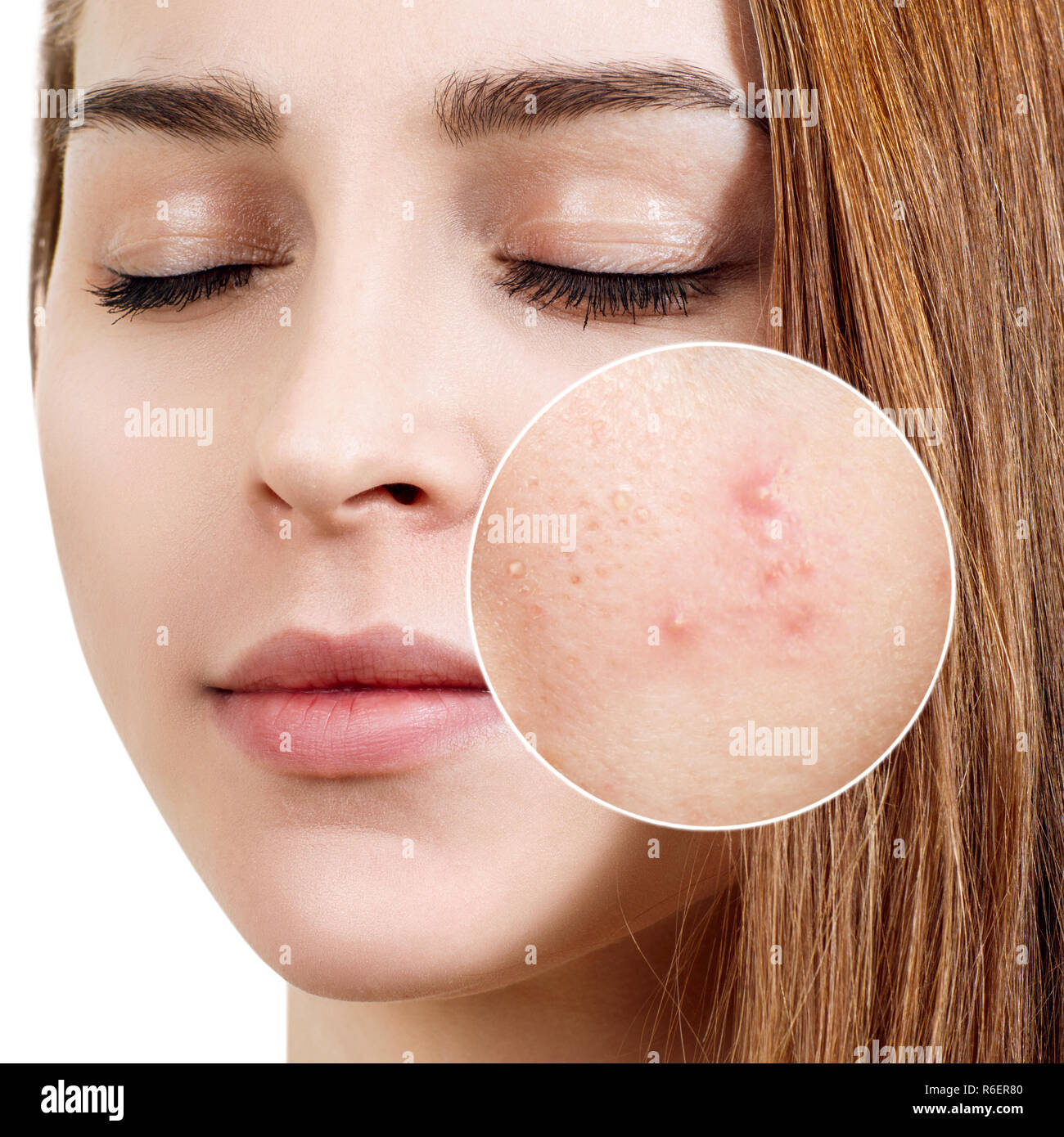 Junge Frau mit Akne Haut im Zoom Kreis. Stockfoto