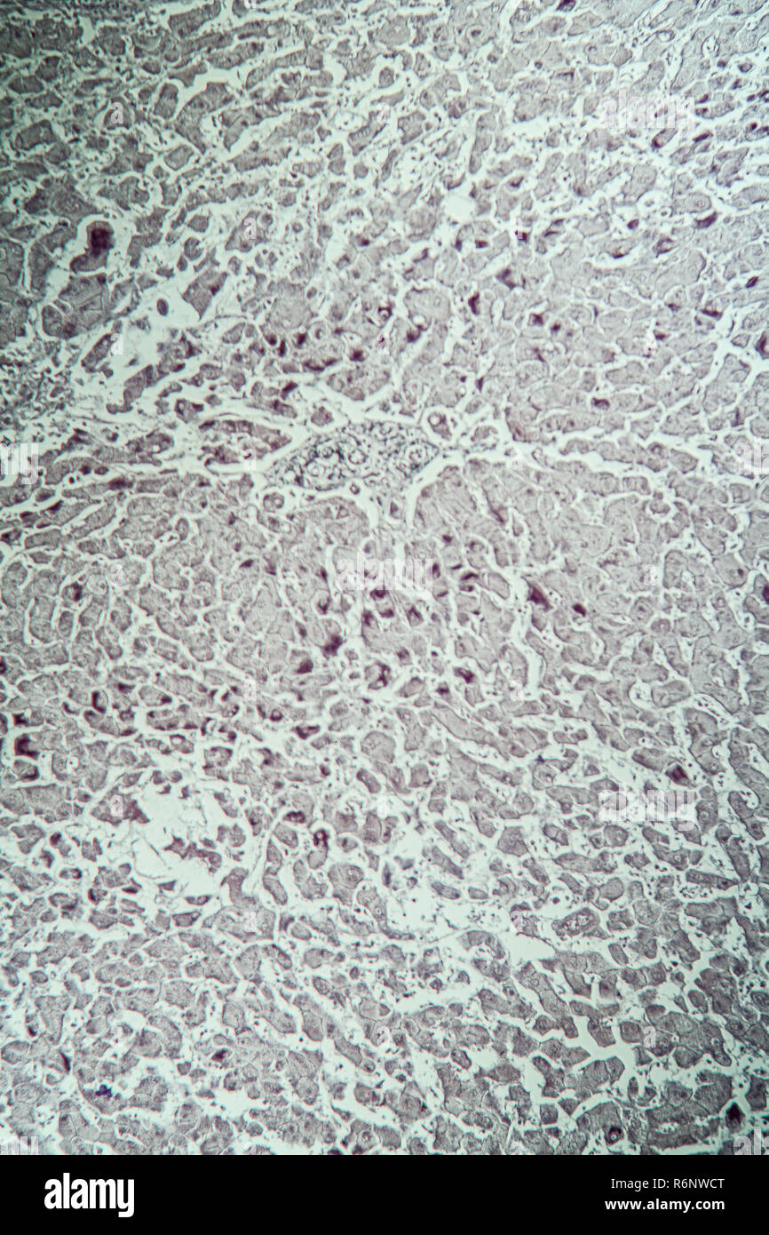 Leber mit Hepatitis Marker unter dem Mikroskop Stockfoto