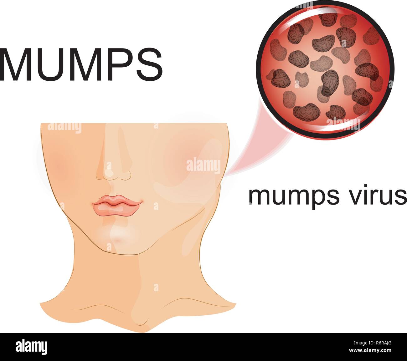 Vector Illustration des Kindes beeinträchtigt durch Mumps. für Publikationen in der medizinischen Broschüren Stock Vektor