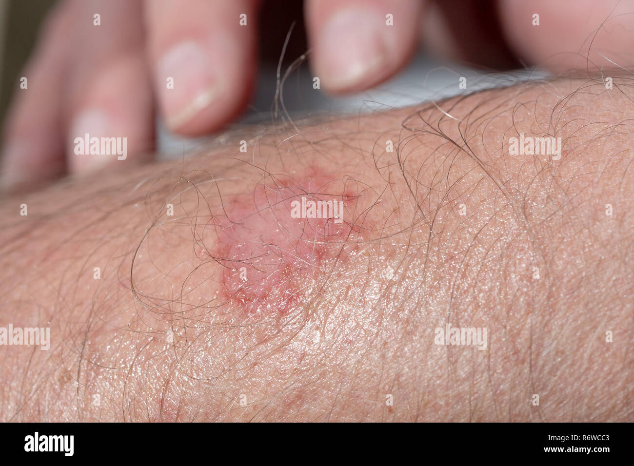 Ekzem auf dem Arm eines Mannes Stockfoto