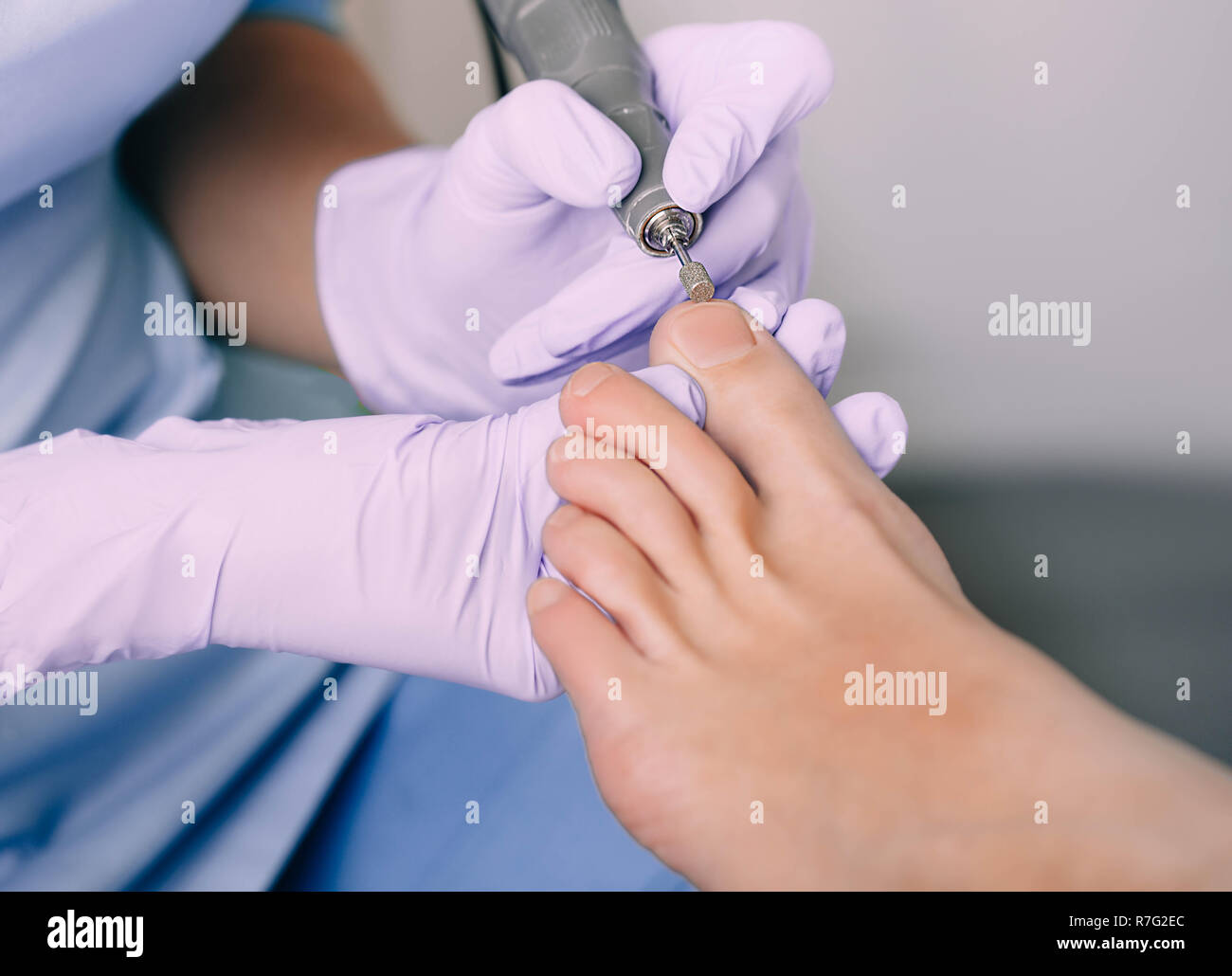 Fußpflege Behandlung von Fuß des Patienten, Pediküre Behandlung Stockfoto