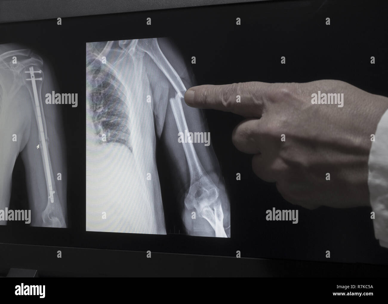 Auf dem Monitor ist ein Röntgen des Bruchs mit der Hand die Hand des Arztes, der auf einen Bruch angezeigt. Das zweite Bild auf dem Bildschirm ist h Stockfoto
