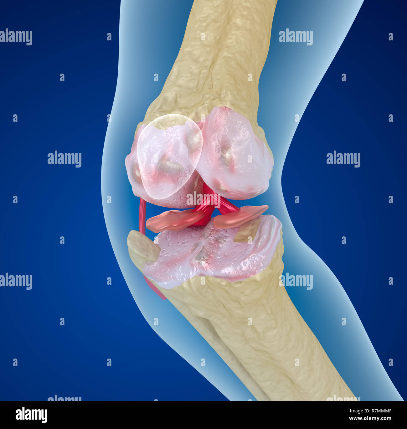 Osteoporose der Knie gemeinsamen, medizinisch genaue 3D illustration Stockfoto
