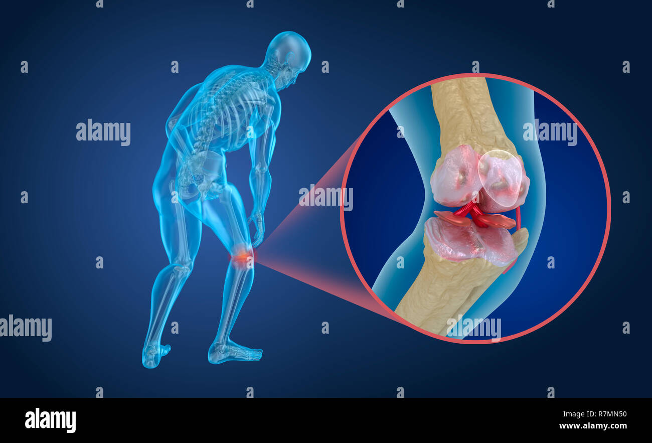 Osteoporose der Knie gemeinsamen, medizinisch genaue 3D illustration Stockfoto