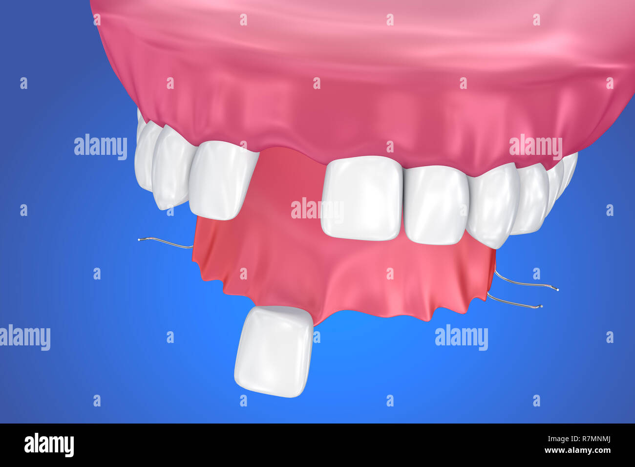 Einzelne fehlende Zahn - herausnehmbare Teilprothese. 3D-Darstellung Stockfoto