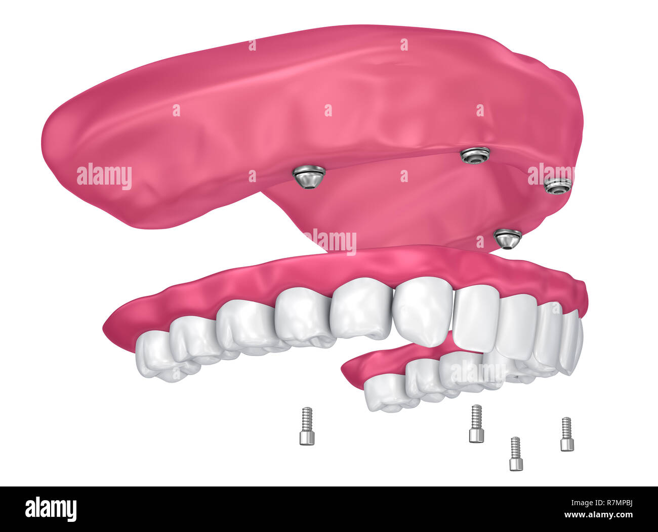 Deckprothese auf Implantaten Anhänge zu sitzen. 3D-Darstellung Stockfoto