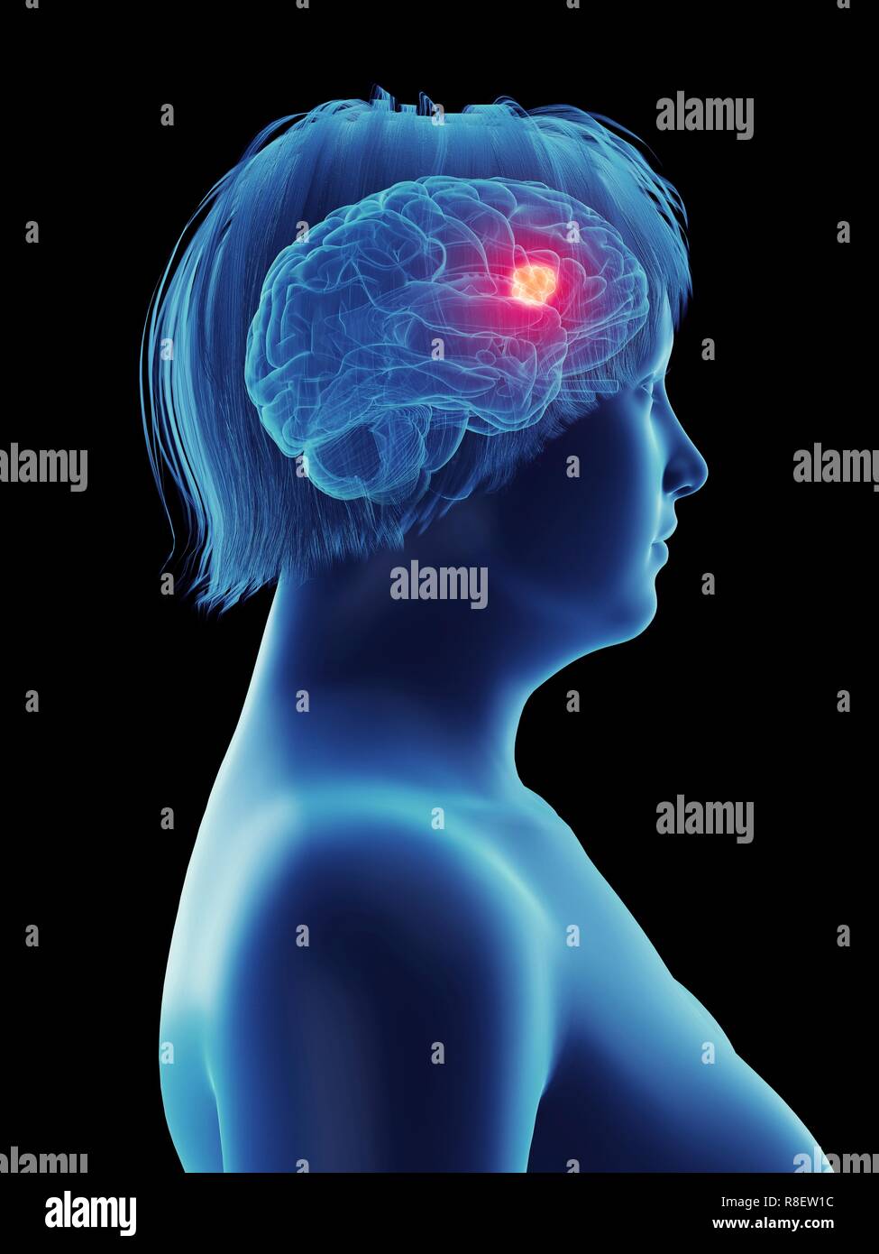 Abbildung ein Tumor im Gehirn der Frau Stockfotografie Alamy Abbildung ein Tumor im Gehirn der Frau Stockfotografie Alamy