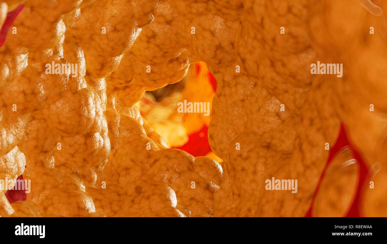 Abbildung: Fett in einer Arterie. Stockfoto