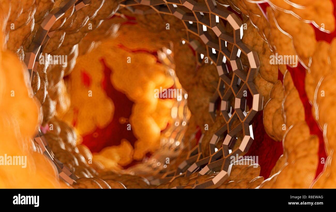 Abbildung eines Stents in einem Fettsäuren Arterie. Stockfoto