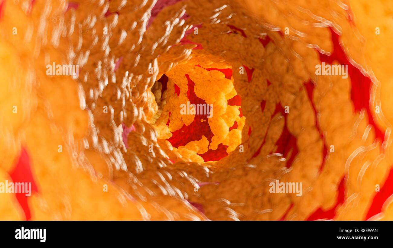 Abbildung: Fett in einer Arterie. Stockfoto