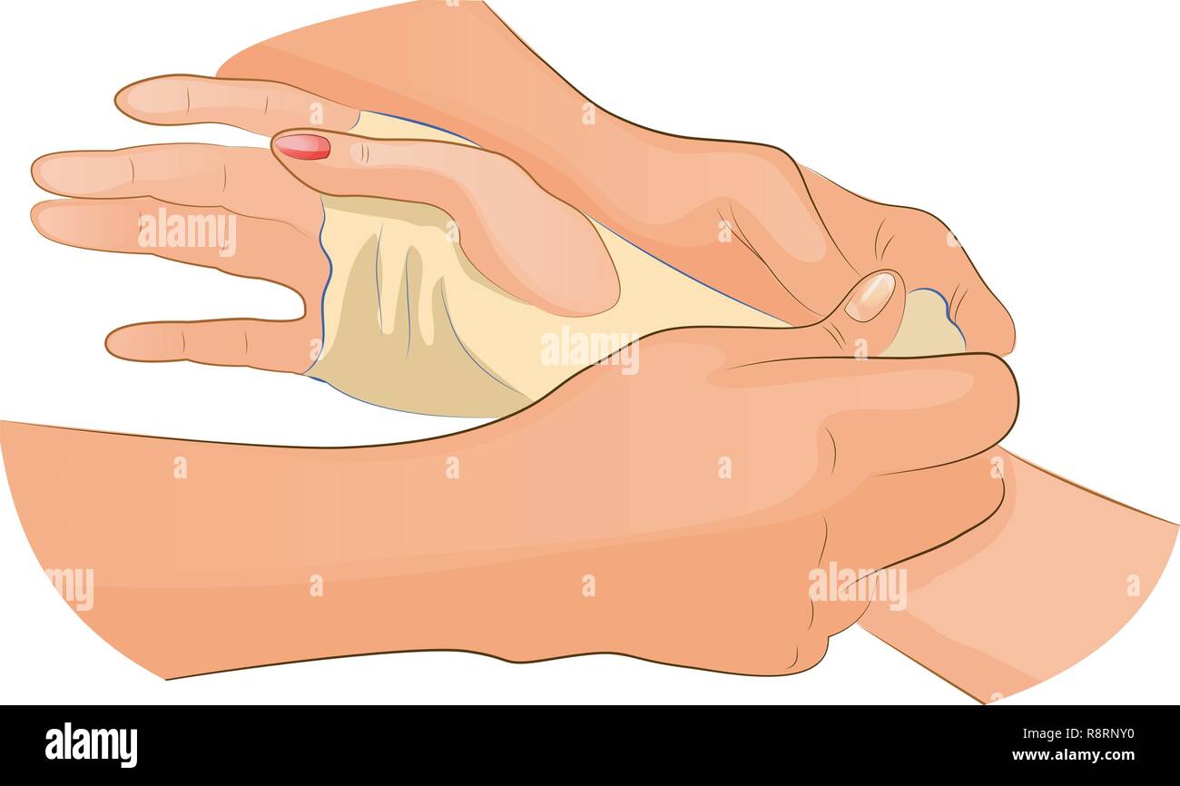 Vector Illustration einer Bandage bei Verletzung von Handgelenk Stock Vektor