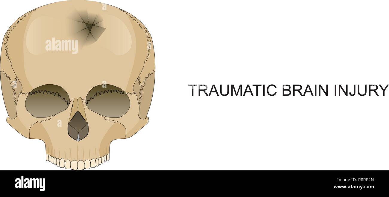 Vector Illustration von traumatischen Hirnverletzungen. Schäden an den Knochen des Schädels Stock Vektor