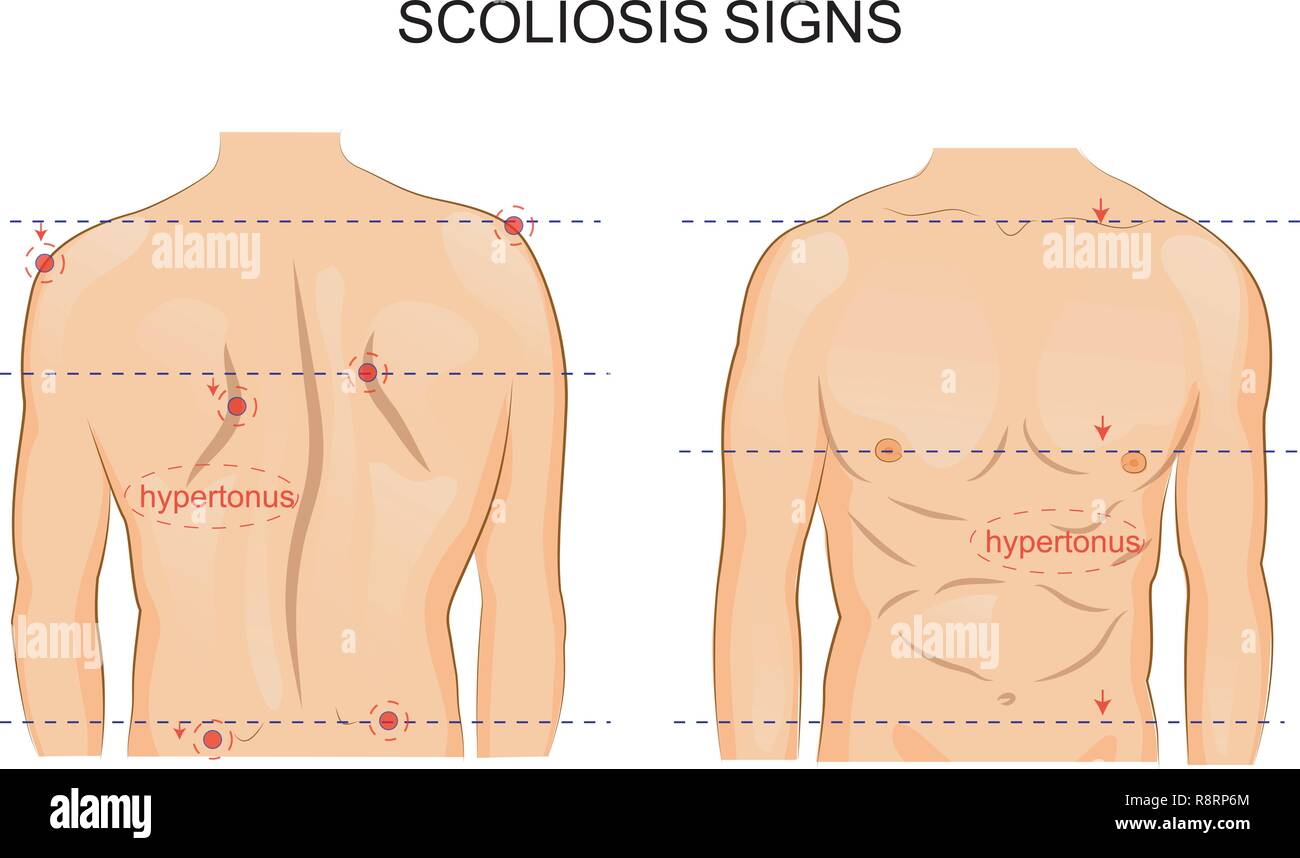 Vector Illustration einer Skoliose der Wirbelsäule. Zeichen Stock Vektor