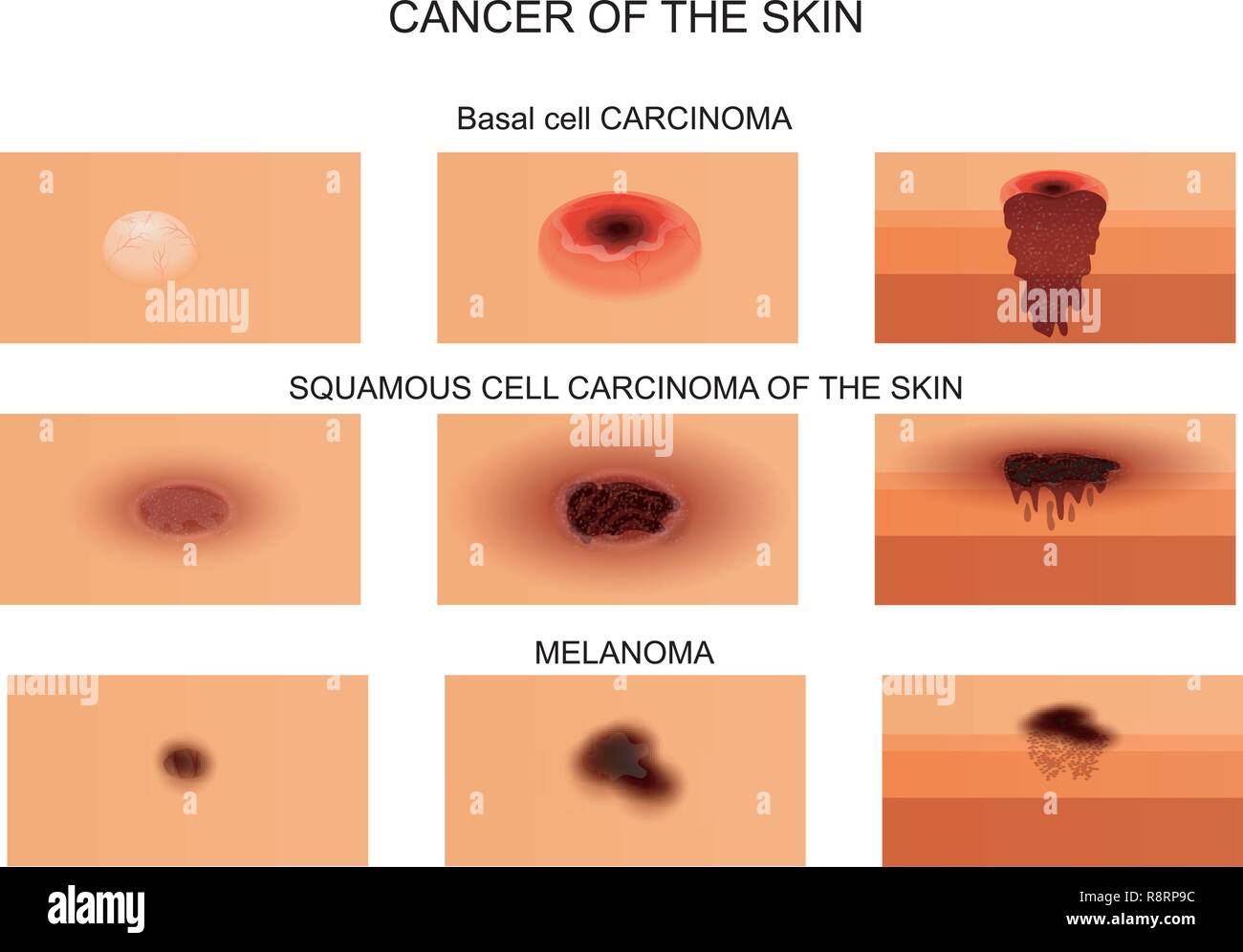 Vector Illustration von Hautkrebs. bereits in der ersten Phase und in der Phase der Nekrose. der Schnitt. Stock Vektor