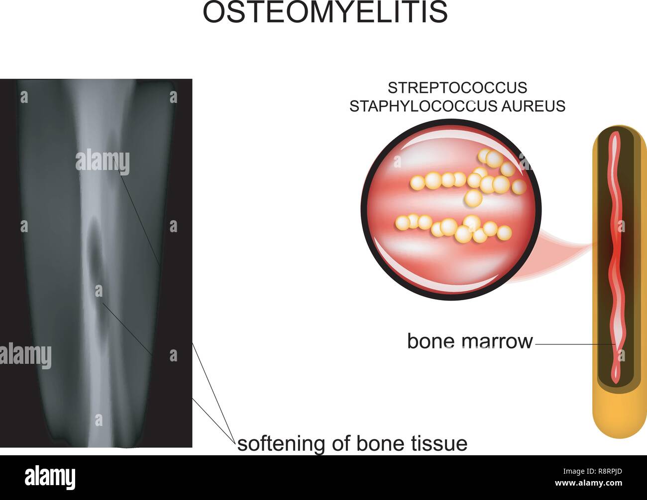 Vector Illustration der Knochenläsionen osteomyelitis Stock Vektor