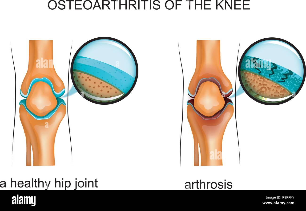 Vector Illustration der Osteoarthritis des Knies Stock Vektor