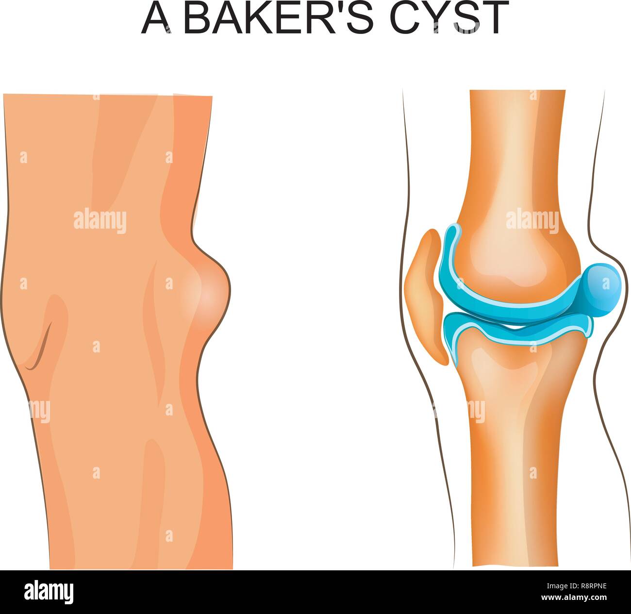 Vector Illustration der Baker Zyste. Unfallchirurgie und Orthopädie Stock Vektor