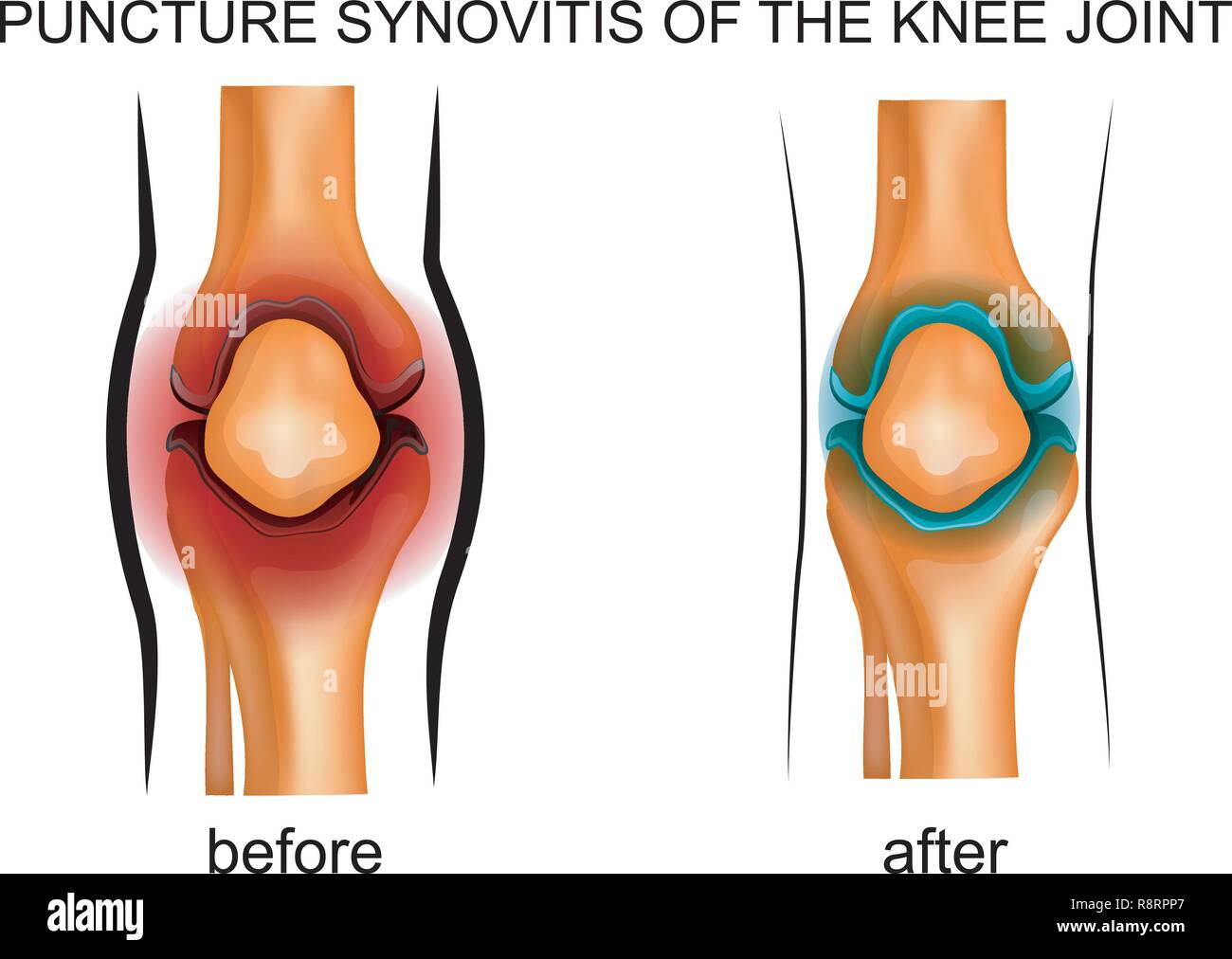 Vector Illustration einer Reifenpanne synovitis des Kniegelenkes Stock Vektor