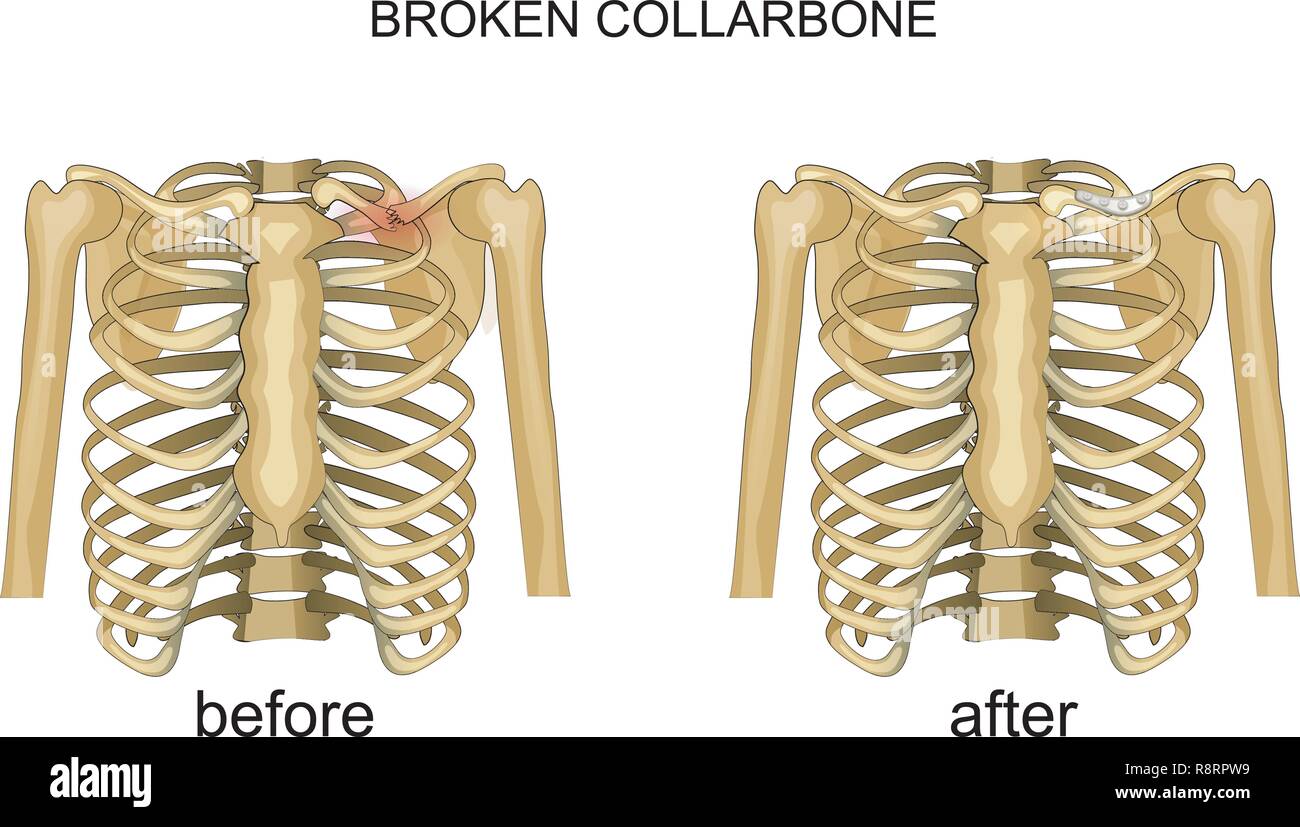 Gebrochene Rippe Stockfotos & Gebrochene Rippe Bilder - Alamy