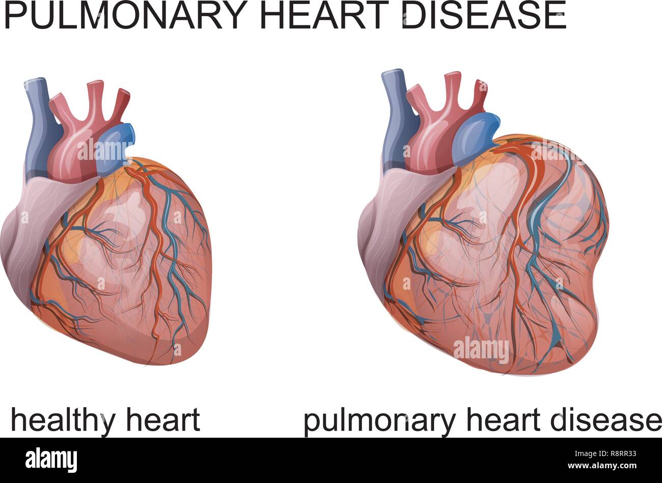 Vector Illustration der pulmonalen Herzkrankheit. Kardiologie Stock Vektor