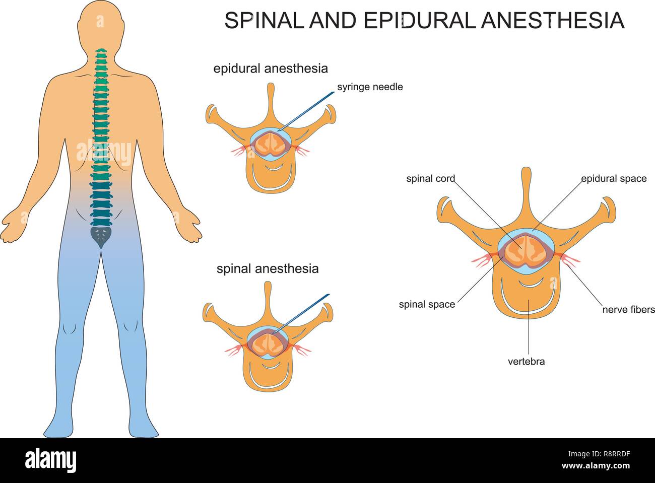 Vector Illustration der epiduralen und spinalen Anästhesie Stock Vektor