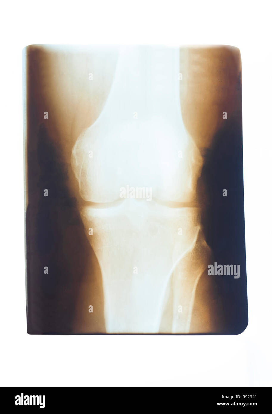 Medical x-ray eines kranken knie auf weißem Hintergrund Stockfoto