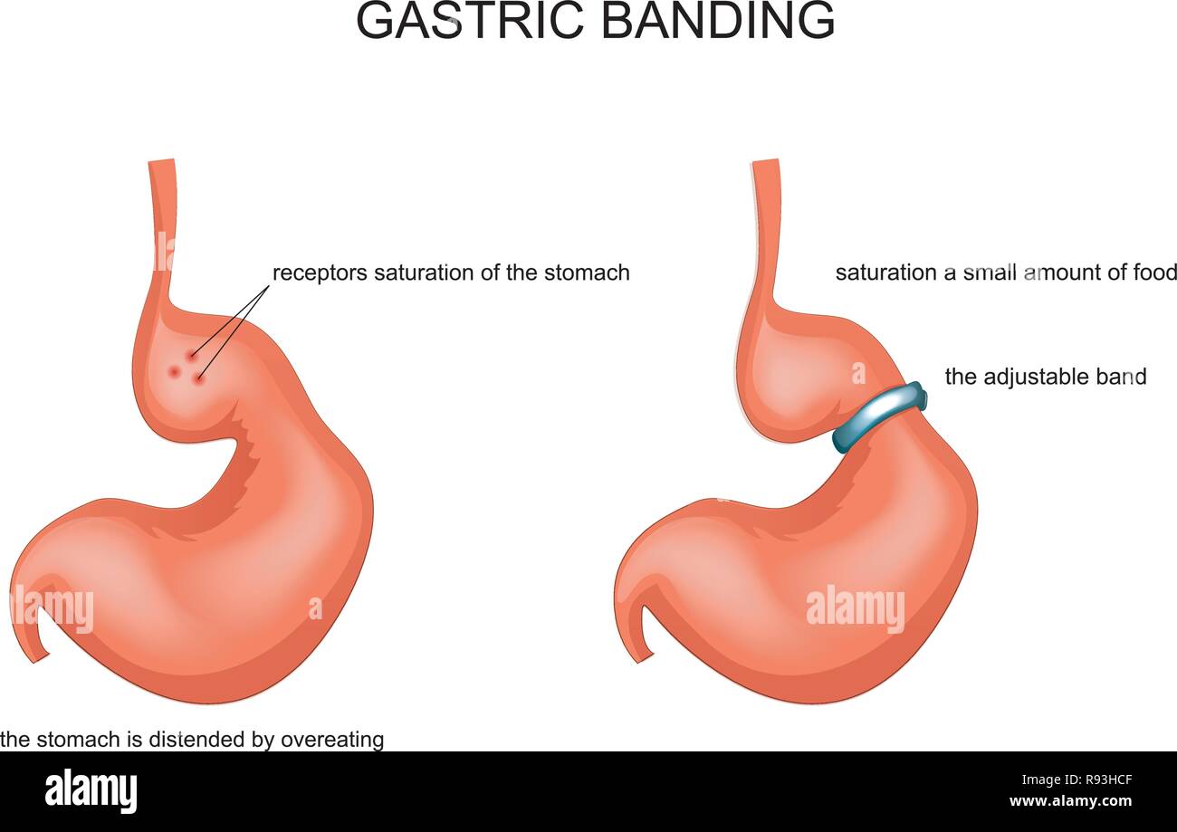 Vector Illustration von Gastric Banding, von Überessen gestreckt Stock Vektor